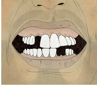 Illustration of a mouth with missing teeth