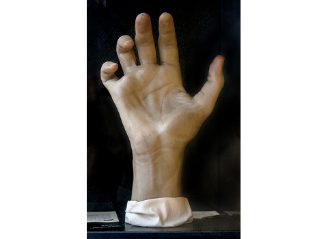 In addition to her illustrations, Maria Wishart also made several hundred wax models of pathological conditions and surgical techniques. The curled fingers on this hand, called main-en-griffe,  are due to a nerve lesion. Model: Maria Torrence Wishart