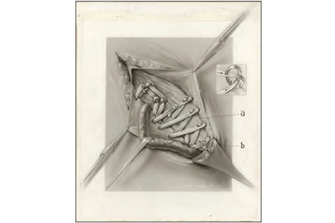 Carbon-dust image of a “living sutures” ventral hernia repair, drawn in 1924. The then-new technique involved using strips of tissue instead of thread. Illustration: Maria Wishart