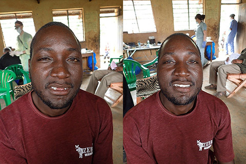A Ugandan man, before and after restorative dental treatment.