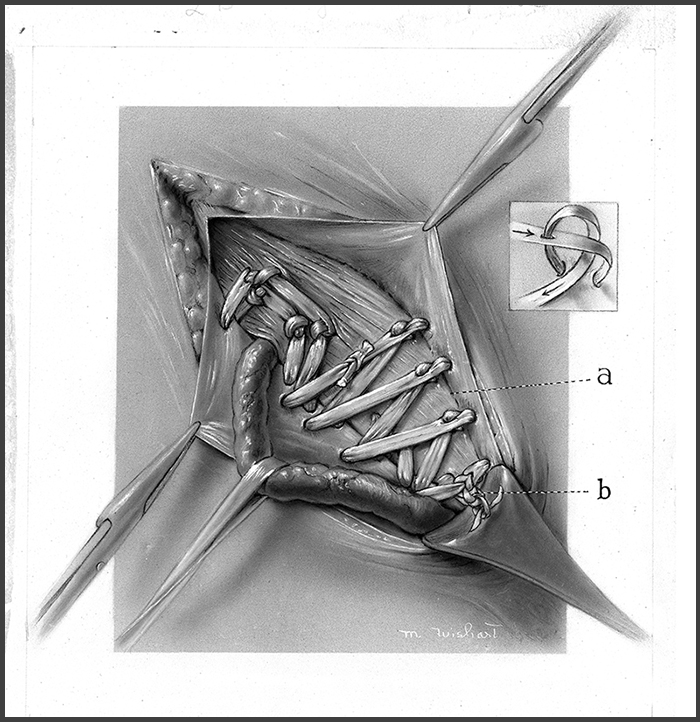 Black and white illustration of a ventral hernia repair, showing strips of tissue used as sutures