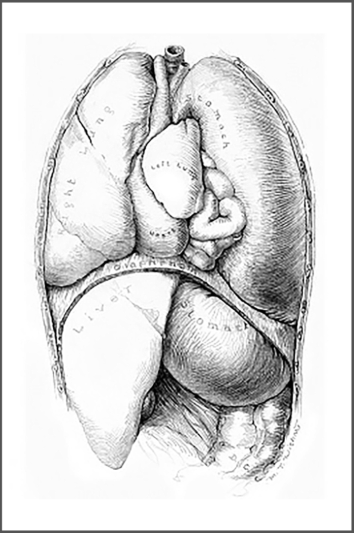 Sketch of a diaphragmatic hernia, showing the placement of different organs, including liver, lung, stomach and heart.