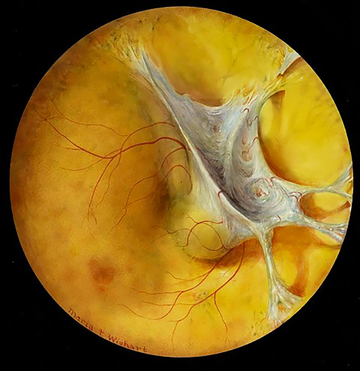 Painting of a retina, depicting a yellow circle with a white orb surrounded by a white membrane appearing off centre